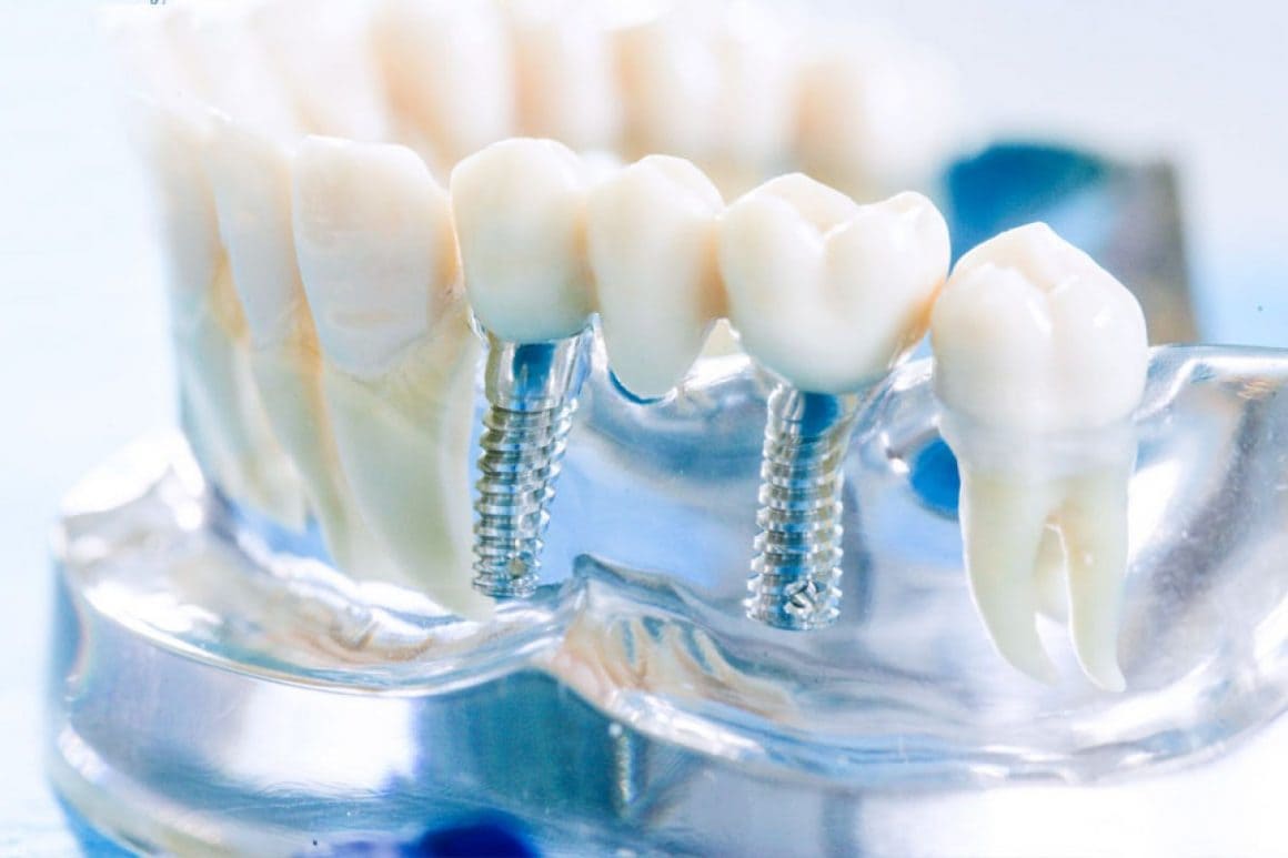 Протезирование зубов на имплантах - фото